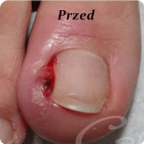 wrośniety paznokiec przed zabiegem na wrastające paznokcie I Mińsk Mazowiecki